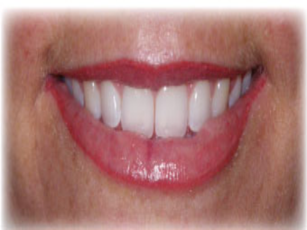 After Photo of Lip Treatment at MPi Clinic San Diego